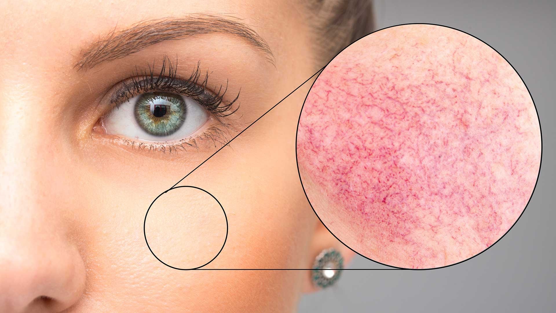 nega kuperozne kože